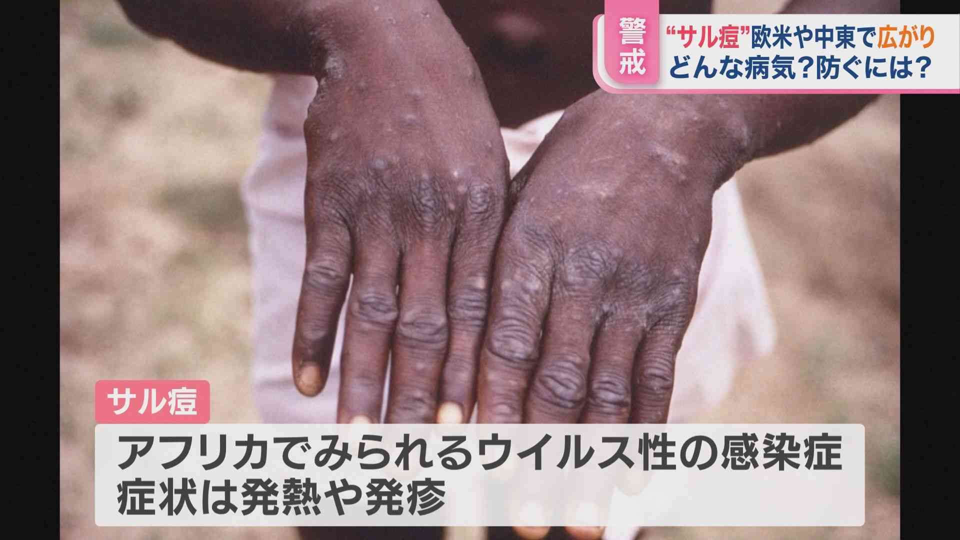 マスク生活で免役力低下か？　“サル痘”感染 世界で広がる【ひるおび】 | TBS NEWS DIG (2ページ)