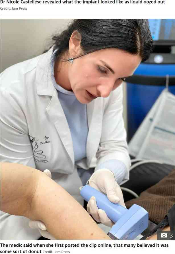 【海外発！Breaking News】まるでさつま揚げ！　破損し除去した35年超の豊胸バッグに衝撃（米）＜動画あり＞ | Techinsight（テックインサイト）|海外セレブ、国内エンタメのオンリーワンをお届けするニュースサイト