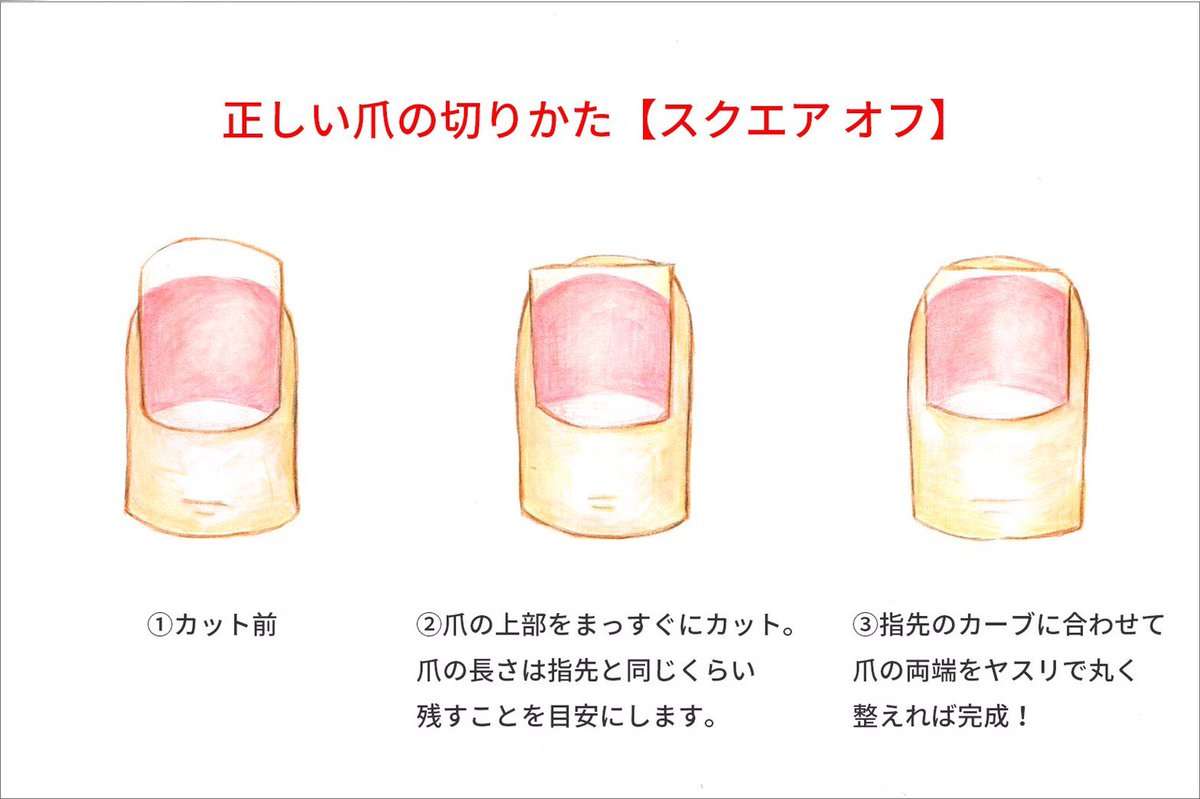 「足の爪の端の白い部分を切らないでください」「切って尖った部分が足の肉に刺さって…」巻き爪外来からのお知らせが話題