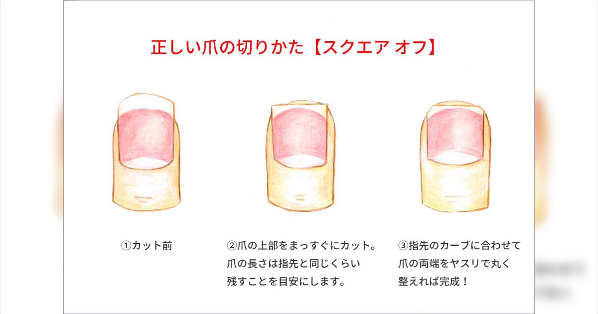 足の爪の端の白い部分を切らないでください。巻き爪治そうとして丸切りするのは逆効果です。切って尖った部分が足の肉に刺さってめちゃくちゃ痛くて手に負えなくなります。金具を爪に入れたりと色んな治療法があるけど治療には時間もお金もかかります。治療より予防。巻き爪外来からのお知らせでした - Togetter