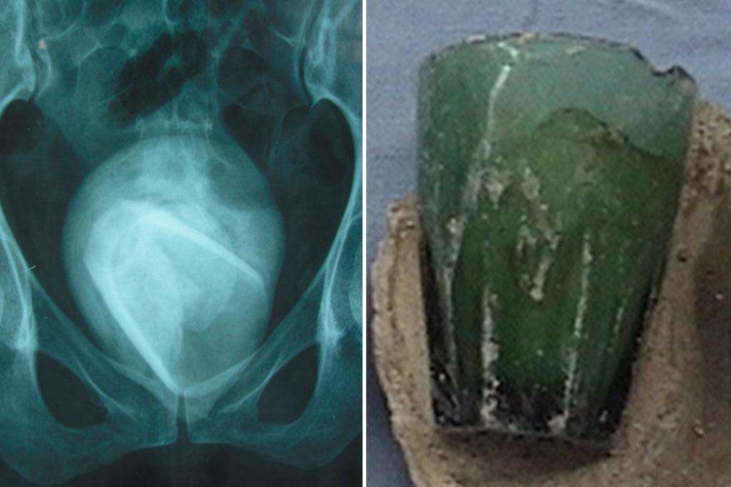 Woman’s ‘UTI’ was actually glass tumbler lodged in bladder for 4 years