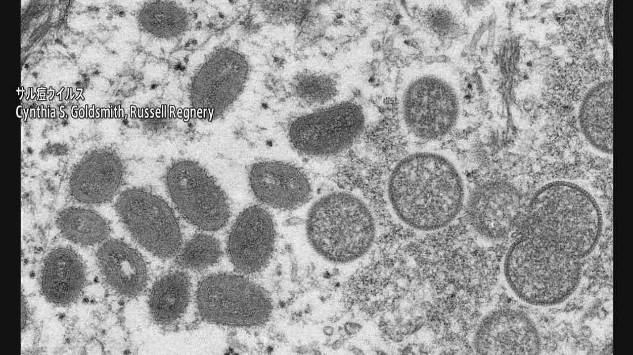サル痘感染1万人超える 米国 - Yahoo!ニュース