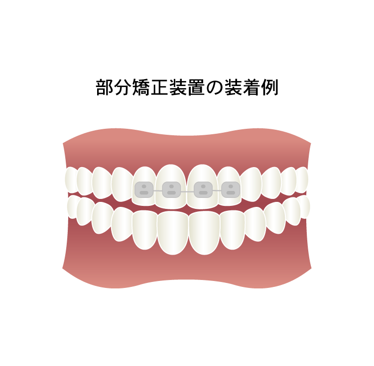 部分歯列矯正