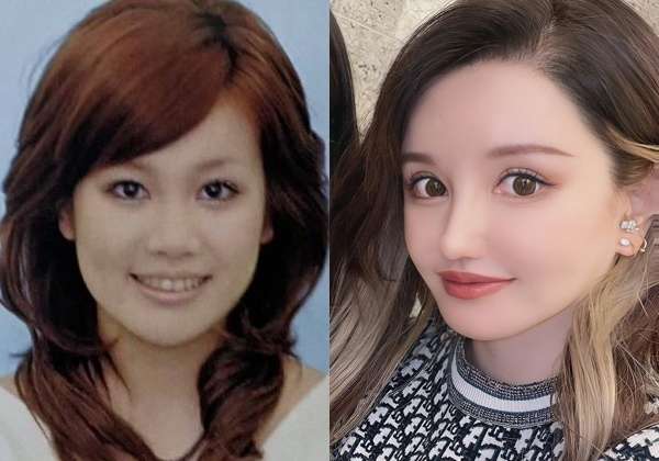 “離れ目の童顔になりたい”眼球の位置を変えようとした女性 “フル整形4周目”突入も「もうこれ以上はできないのがつらい」