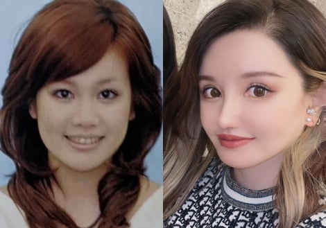 “離れ目の童顔になりたい”眼球の位置を変えようとした女性　“フル整形4周目”突入も「もうこれ以上はできないのがつらい」 ｜最新ニュース｜eltha（エルザ）