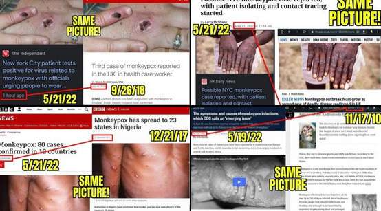 【存在しないサル痘ウイルス】陽性者の「濃厚接触者」にワクチン接種可能に！？ | 泣いて生まれてきたけれど