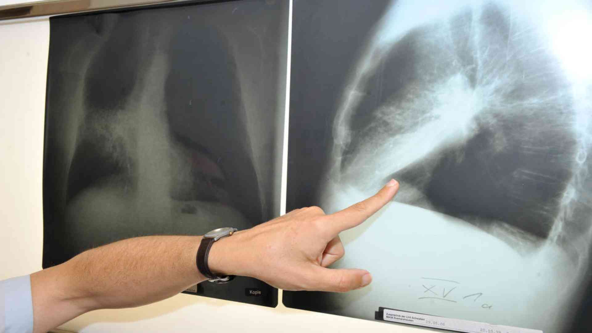 Cancer expected to kill 18,000 Swiss this year - SWI swissinfo.ch
