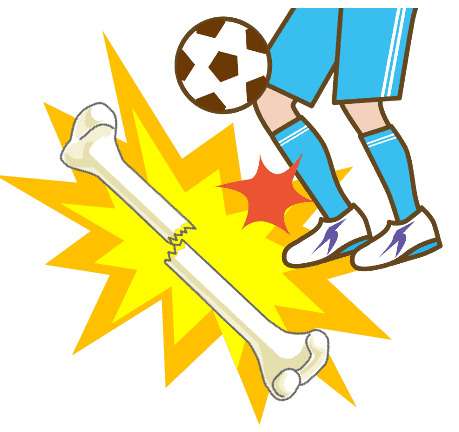 今、子どもの骨が危ない！子どもの疲労骨折が3倍に増加している理由とは？骨を丈夫にする方法をご紹介！｜STORY（magacol） - Yahoo!ニュース