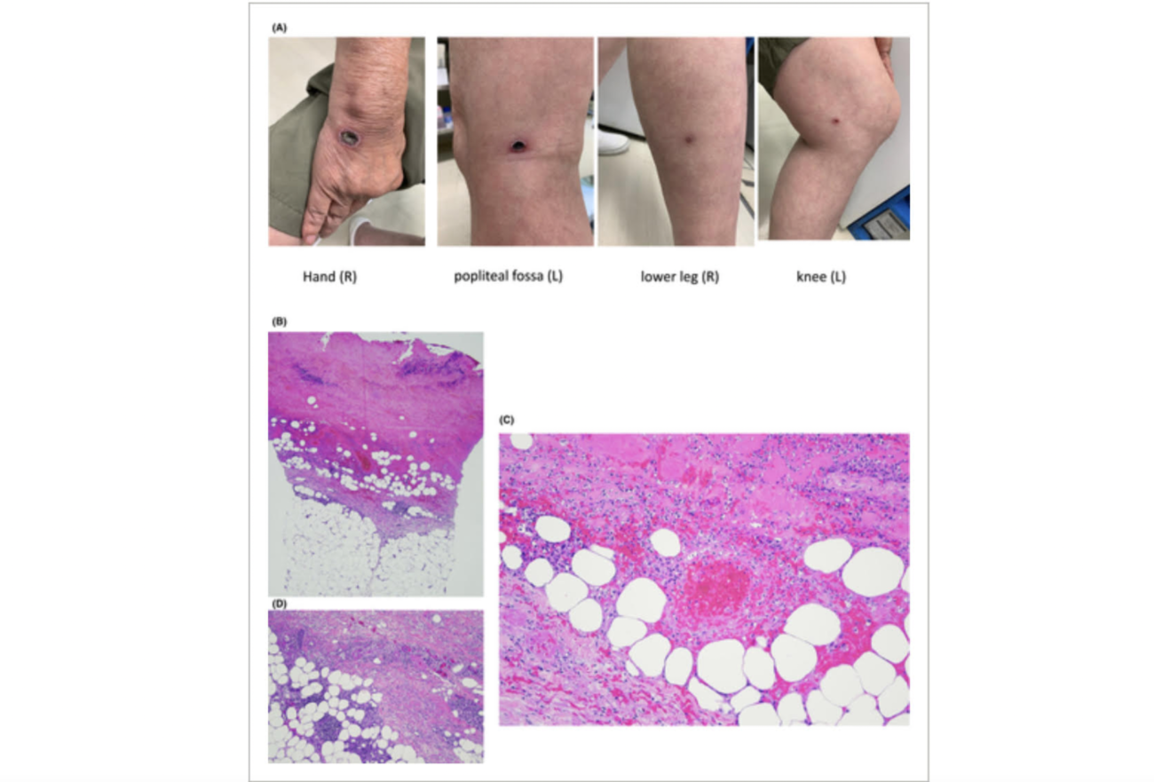 高知大学研究チームがコロナワクチンの危険性を論文で発表　初回接種で「水痘」を発症、2回目接種でさらに悪化、3ヶ月症状が続き、皮膚からスパイク蛋白を検出  |  RAPT理論+α