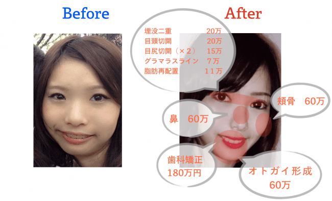 総額420万をかけてコンプレックスを解消　10回の施術から起業した女性「美容整形を努力だという文化を作りたい」