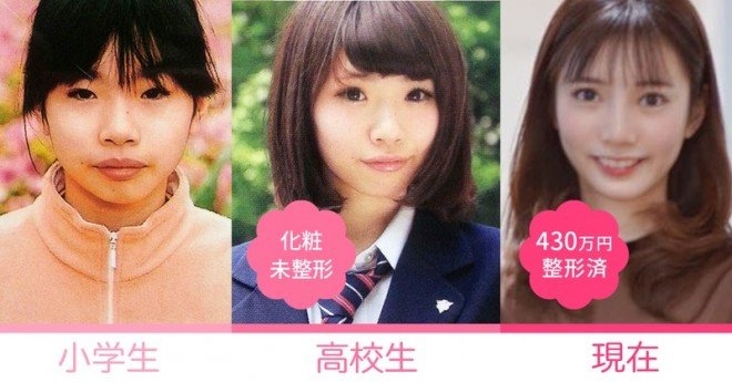 総額420万をかけてコンプレックスを解消　10回の施術から起業した女性「美容整形を努力だという文化を作りたい」