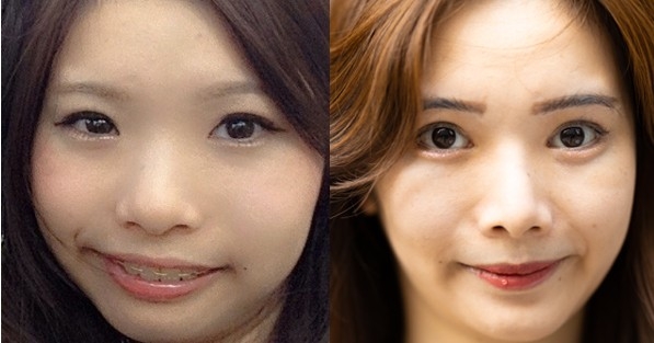 総額420万をかけてコンプレックスを解消　10回の施術から起業した女性「美容整形を努力だという文化を作りたい」｜eltha（エルザ）