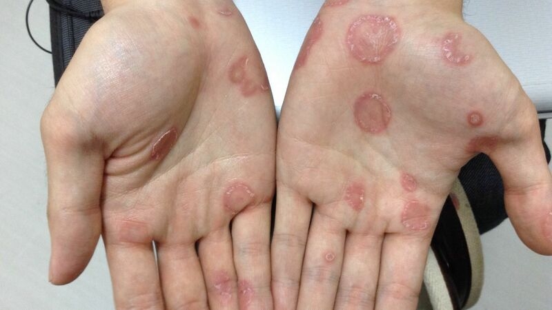 過去最多の感染者数　梅毒ってどんな病気？（忽那賢志） - 個人 - Yahoo!ニュース