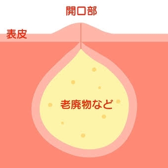 【粉瘤】よくできる人、あつまれ【アテローム】