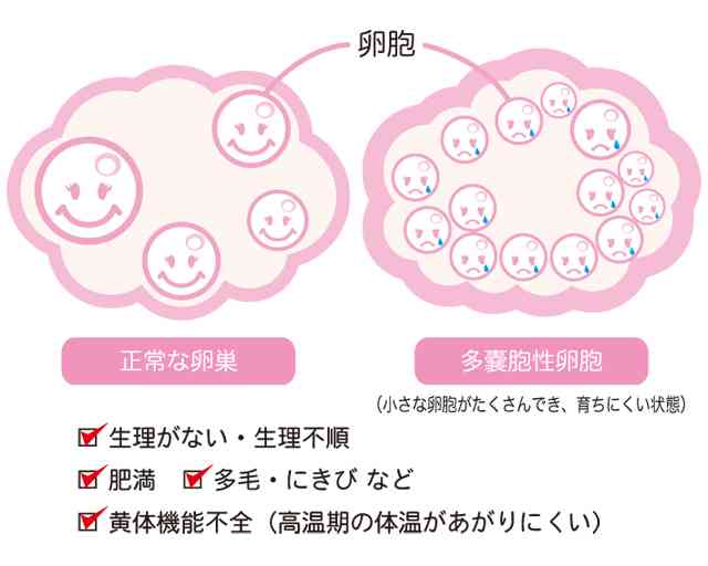 多嚢胞性卵巣症候群の人