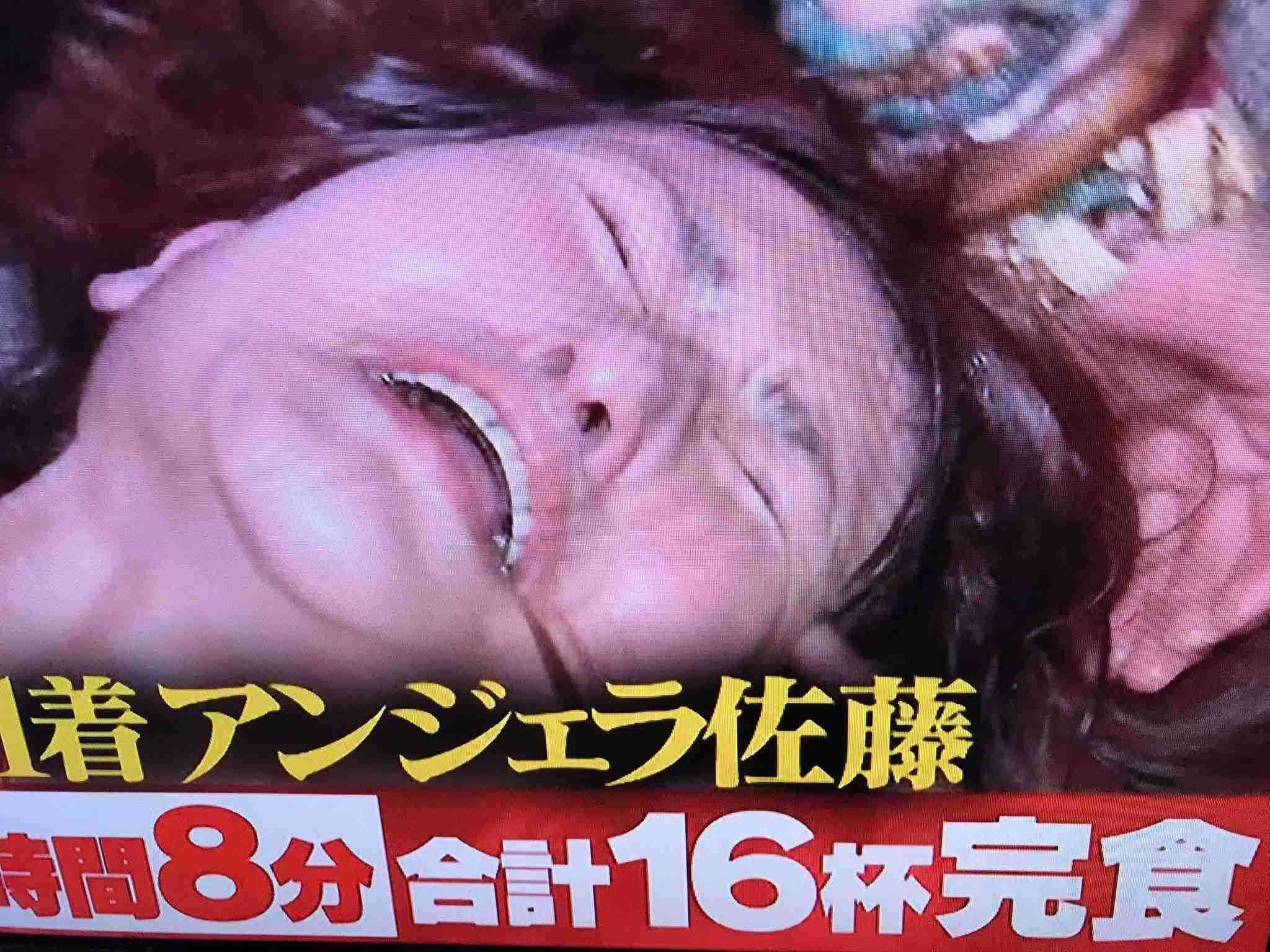 銀歯について