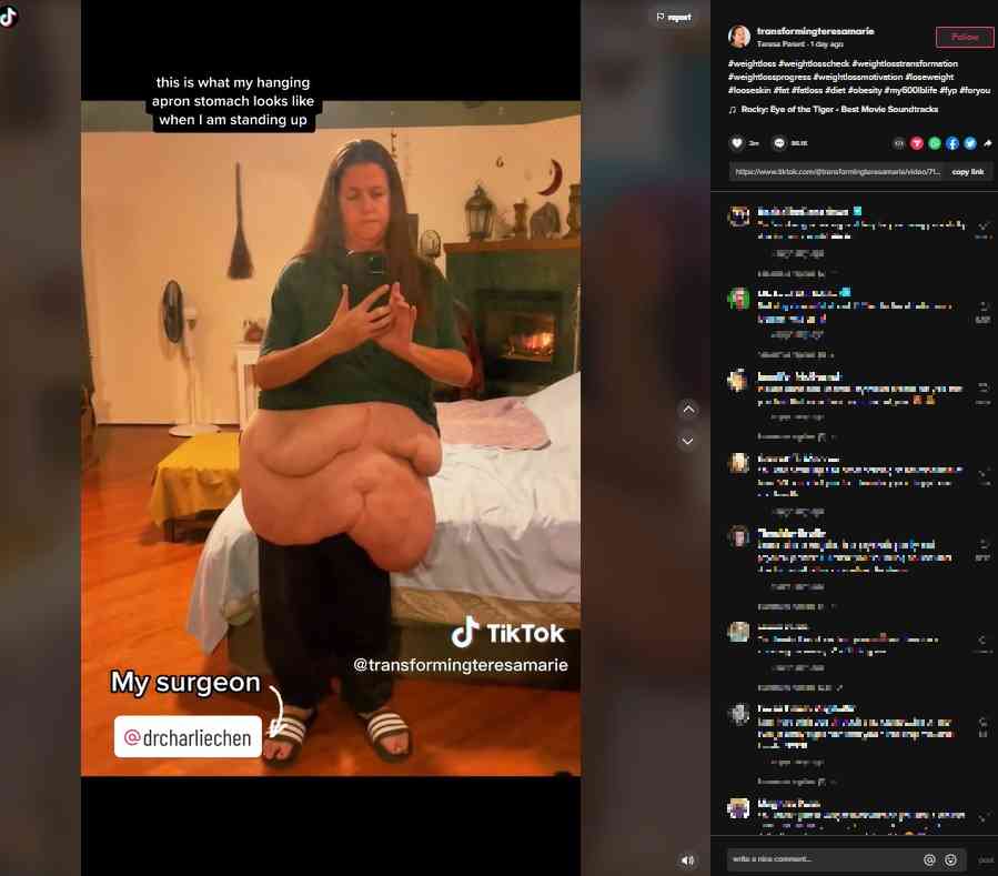 4年半で167キロ減量の女性、お腹の皮膚が膝まで垂れるも“前向き”に（米）
