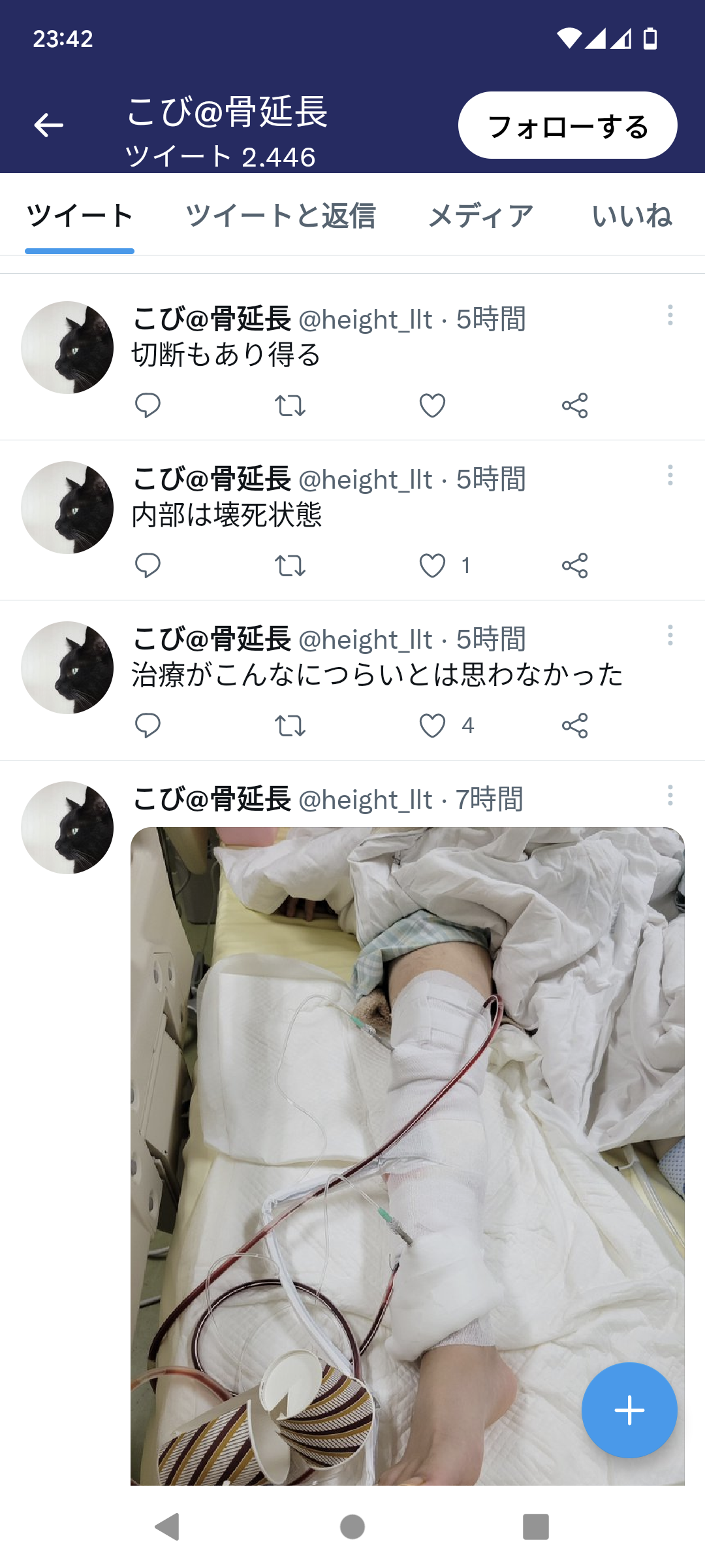 【悲報】身長を伸ばすためにトルコで骨延長手術を受けた男性、骨髄炎になり両足切断の危機 : 速報Ｚ