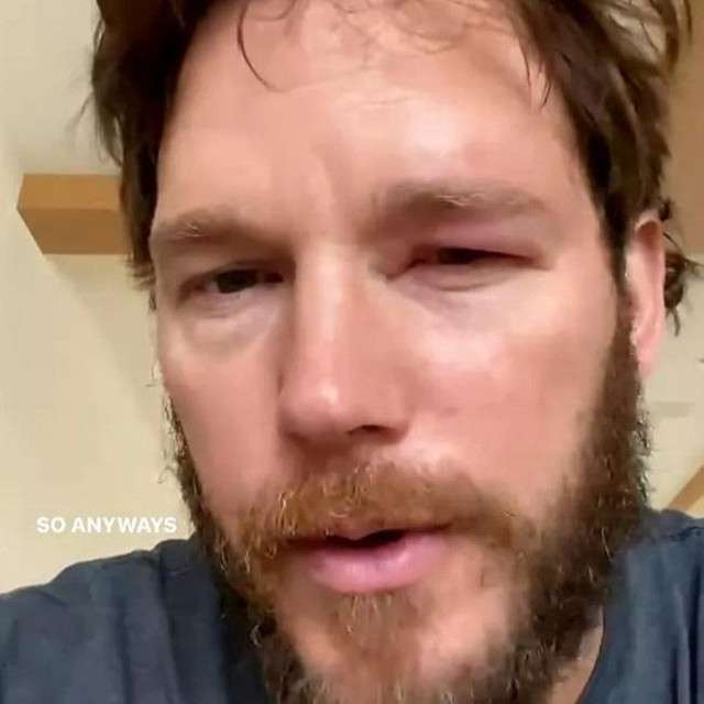 「スーパーマリオ」俳優 蜂に眼球を刺される サングラスとって腫れた目を披露