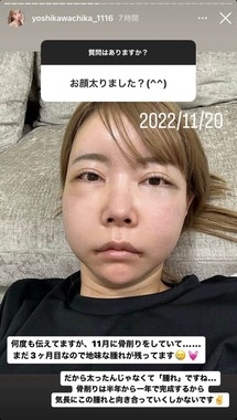 整形2000万モデル「顔太った？」に反論「腫れです」　3か月前に骨削り「半年から1年で完成する」