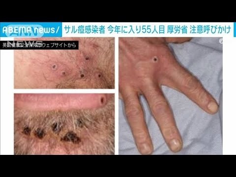 「サル痘」感染者が急増中今年に入り患者55人　厚労省が発疹症状に呼びかけ(2023年3月24日) - YouTube