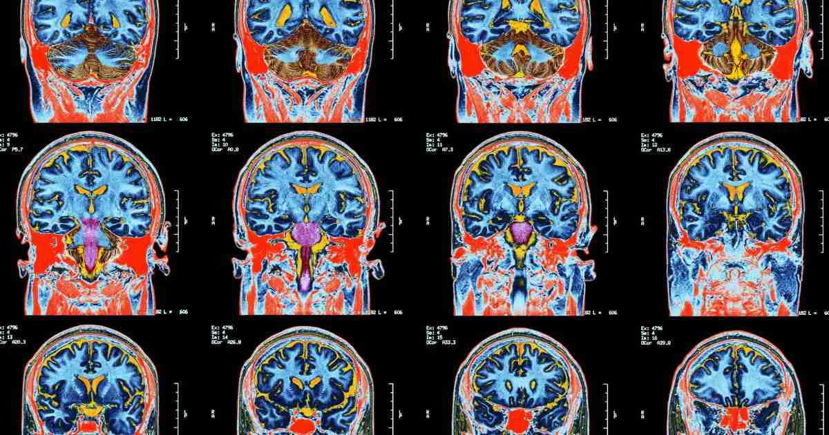 What we now know about long COVID and our brains | Pursuit by The University of Melbourne