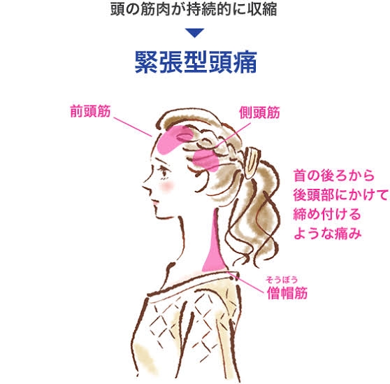 緊張型頭痛がある人