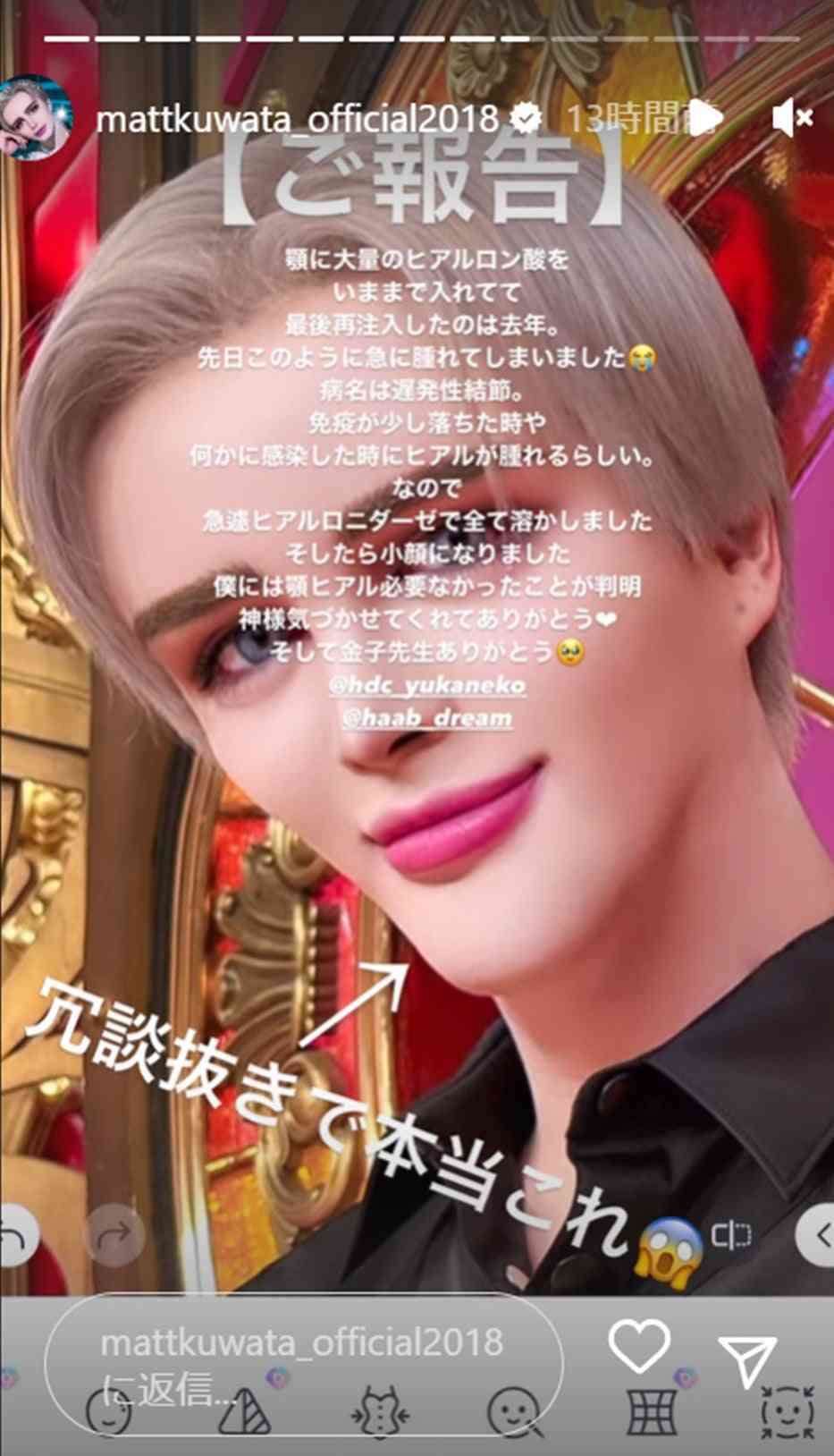 Matt、アゴにヒアルロン酸大量注入で異変→遅発性結節に 現在は思わぬ変化「入れ直して…いい感じ」