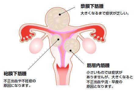 子宮筋腫手術された方