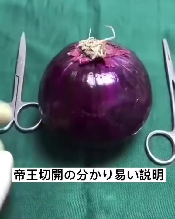 #医療観察 #帝王切開 を分かり易く説明すれば? | TikTok