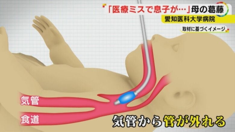 生後7カ月の我が子が突然意識不明に…「医療ミスが原因」 時効迫り提訴した母の苦悩【愛知発】