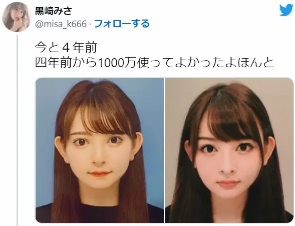 タトゥー「ない方が子供には良い」「実際あったらみんな距離取る」 双子母整形インフルエンサーが除去報告