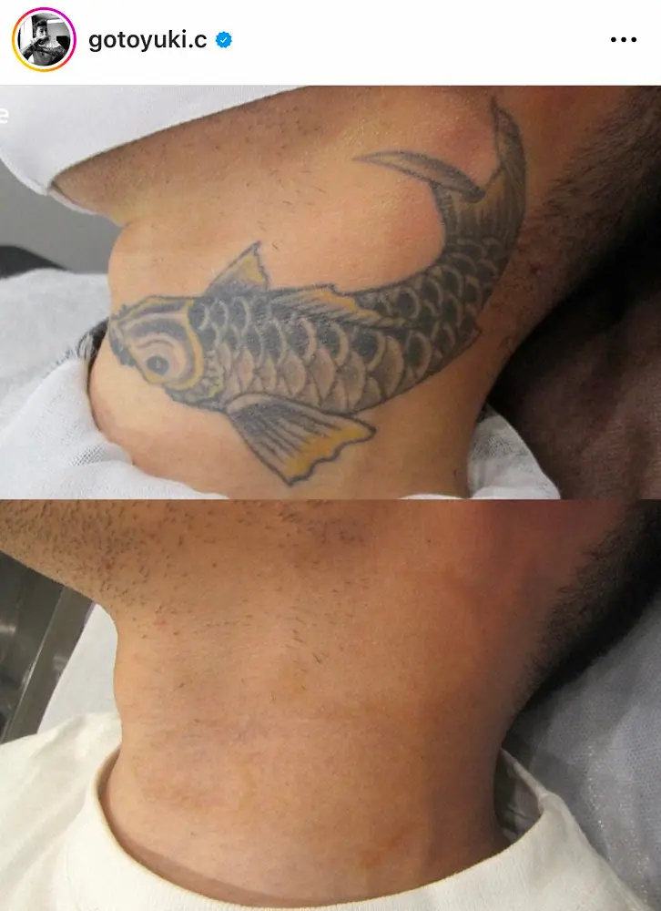 ゴマキ弟「若気の至りで入れた入れ墨」首のタトゥー完全除去　亡き母も「喜んでくれていると思います」― スポニチ Sponichi Annex 芸能