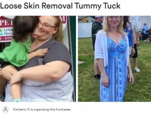 2年で約80キロ痩せた女性、垂れた皮膚に「まるでムササビ！」の声（米）