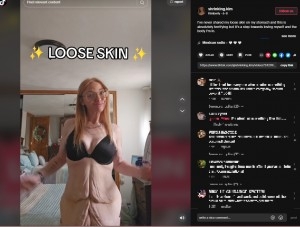 2年で約80キロ痩せた女性、垂れた皮膚に「まるでムササビ！」の声（米）