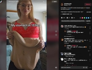 2年で約80キロ痩せた女性、垂れた皮膚に「まるでムササビ！」の声（米）