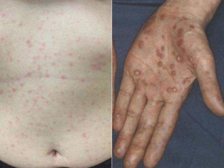 キスなどで感染することも…性感染症『梅毒』の感染者が急増中 医師「不特定多数の人と性交しないのが一番」 | 東海テレビNEWS