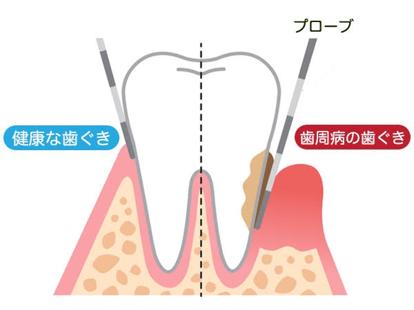 歯周病の手入れ