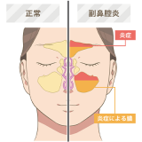 昔から疲れると鼻にくるタイプ。副鼻腔炎にもなった経験があり、ちょっと体調崩すと...
