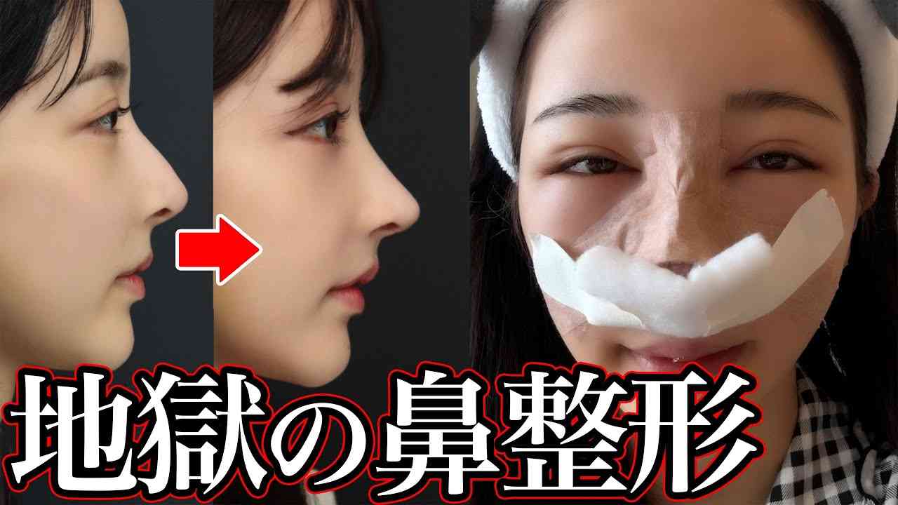 YouTuber・Rちゃん、自身の鼻を整形した医師に仕上がりを“変”だとされ苦言「あなたがデザイン調整したじゃないですか」 | ガールズ ...