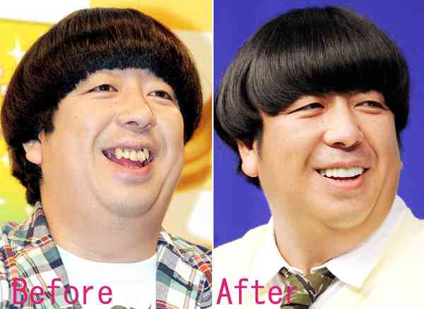 錦鯉・長谷川雅紀、2年半の“歯の治療”が終了　衝撃治療費に「入れなきゃよかった」