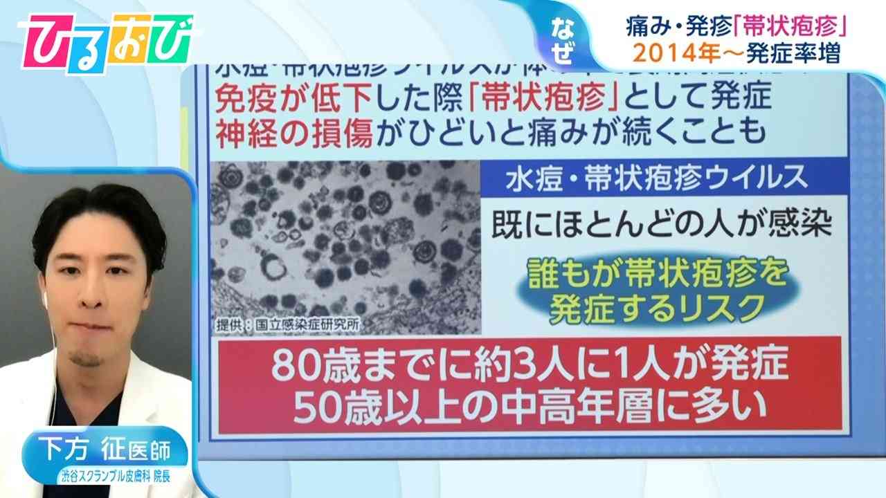 「剣山で刺すような痛み」子育て世代で増加する『帯状疱疹』 気を付けるべき症状を医師に聞く【ひるおび】（TBS NEWS DIG Powered by JNN） - Yahoo!ニュース