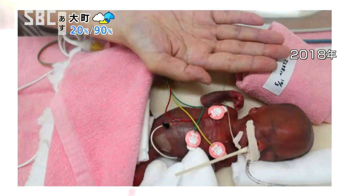 わずか258グラムで誕生 “世界最小の男の子”が元気に5歳に！体重は約40倍の10キロに成長　命つないだ当時の主治医と笑顔の再会