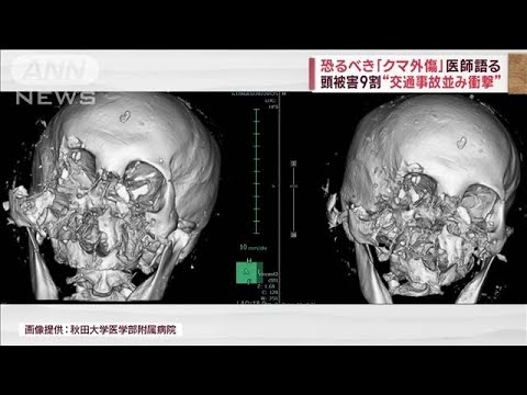 医師が語る恐るべき「クマ外傷」　頭被害9割“交通事故並み衝撃”(2023年11月10日) - YouTube