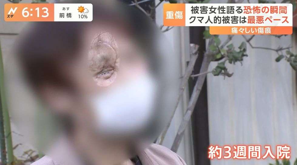 クマにひっかかれ、顔半分の皮がはがれ落ちる…被害の女性「鈴もスプレーも役に立たなかった」
