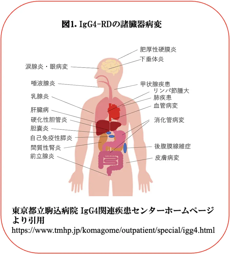 IgG4関連疾患の危険因子としてのCOVID-19 mRNAワクチン ｜ 新型コロナウイルスや医学・生命科学全般に関する最新情報 ｜ 公益財団法人 東京都医学総合研究所
