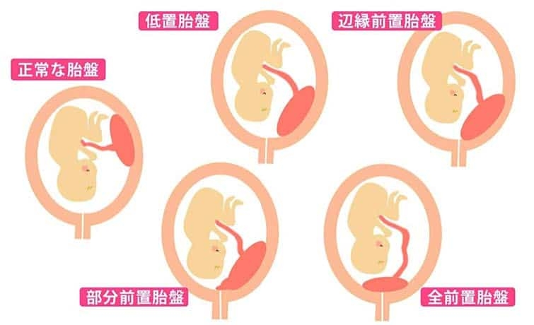 前置胎盤経験した方