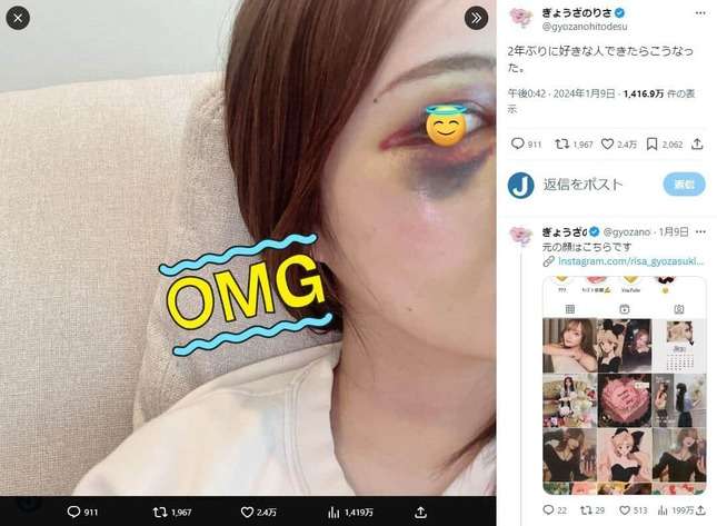 「殴られる様な人間なんでしょ？」顔に大アザもSNSで非難され...　人気インフルエンサー「まじ頭おかしくない？」