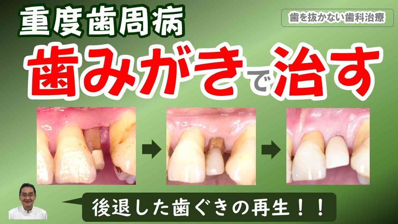 歯周病、歯みがきで治す：後退した歯ぐきがもとに戻る！！！ - YouTube