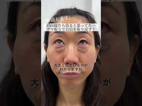 【クマ取り】たっぷり取れた脂肪に驚愕…！#shorts - YouTube